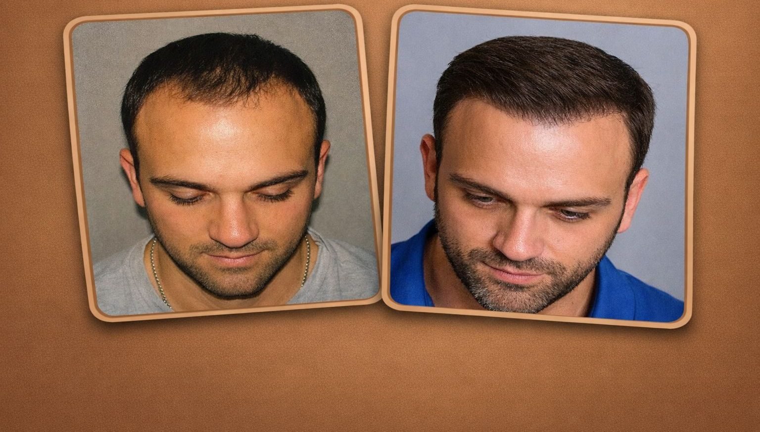 Résultat avant / après d'une greffe de cheveux en Turquie — patient 3 de Global Health Hair